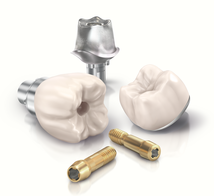 Dental Implants | Southern Cross Dental
